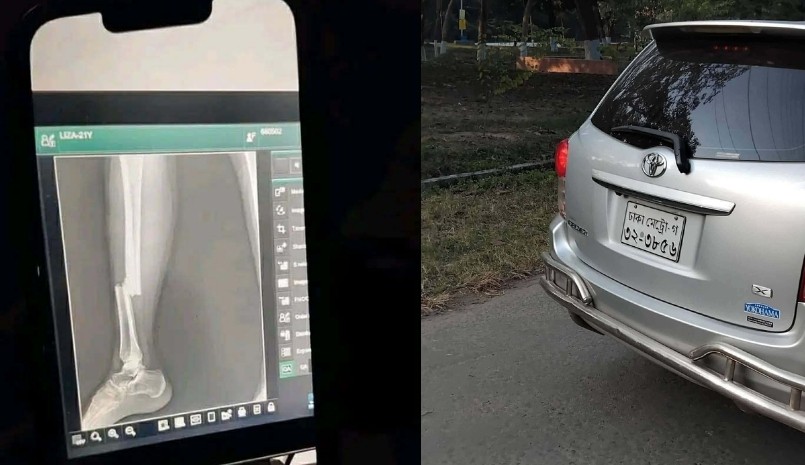 অধ্যাপকের গাড়ির ধাক্কায় পা ভাঙল রাবি ছাত্রীর